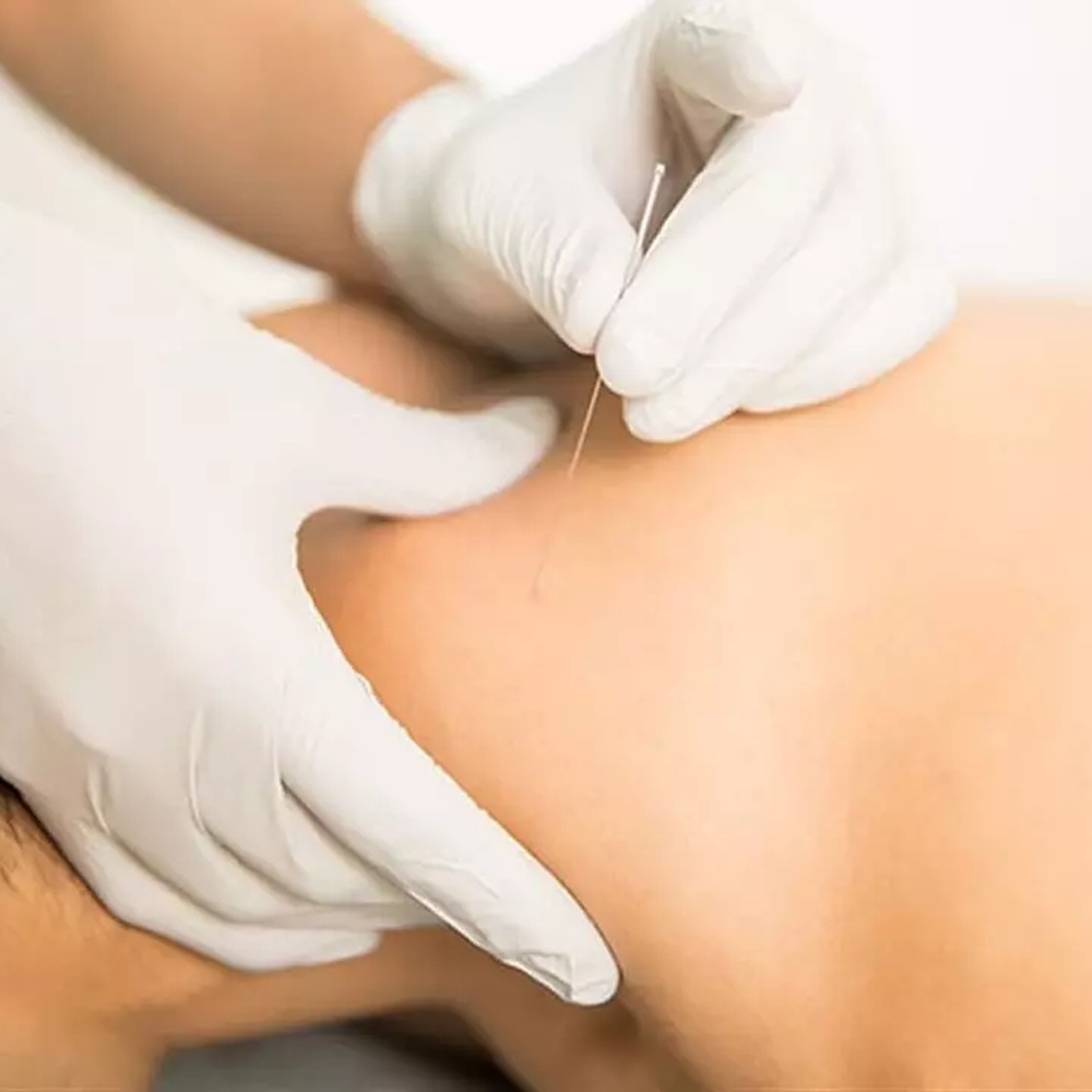 Kuru İğne Tedavisi Nedir ?