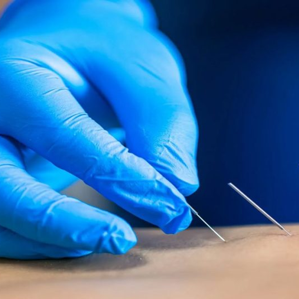 Kuru İğne Tedavisinin Yan Etkisi Var mıdır?