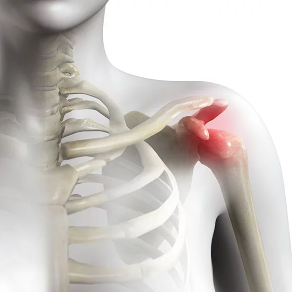 Omuz İncinme (İmpingement) Sendromu